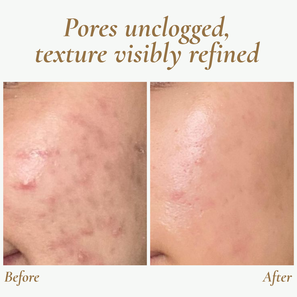 Ultraljudsskrubber för hudförnyelse - Resevänlig ansiktsapparat