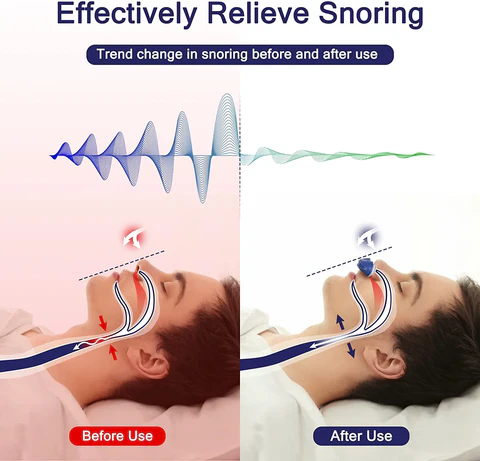 Bärbar mikro-CPAP-apparat - Resevänlig lösning mot snarkning och lindring av sömnapné