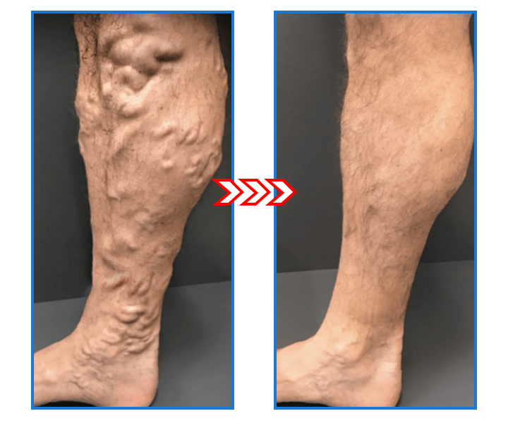 Kompressions- och stretchterapistrumpor – Stödjande jonisk komfort för dagligt bruk