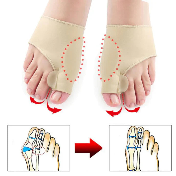 Ortopedisk tåkorrigerare (1 par) - Hallux Valgus-stöd och smärtlindringshölje