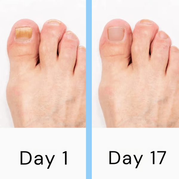 Lasernagelterapiapparat – Avancerad svampdödande behandling för tånaglar och fingernaglar